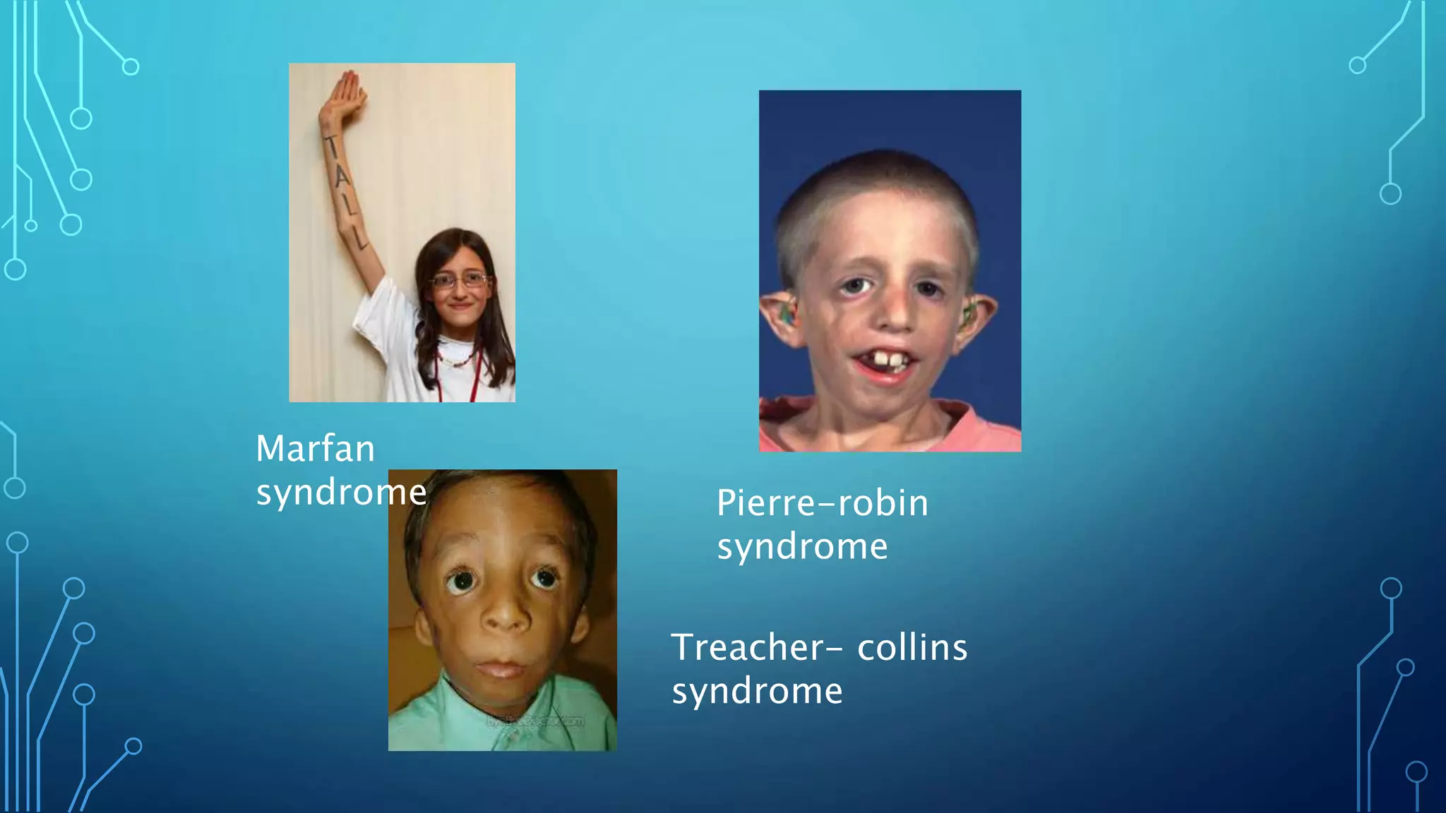 Marfan
syndrome Pierre-robin
syndrome
Treacher- collins
syndrome
 