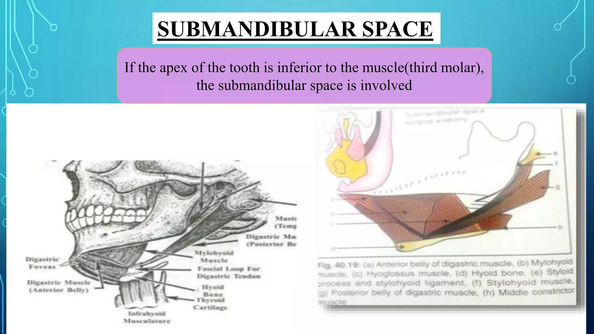 SUBMANDIBULAR SPACE
If the apex of the tooth is inferior to the muscle(third molar),
the submandibular space is involved
 