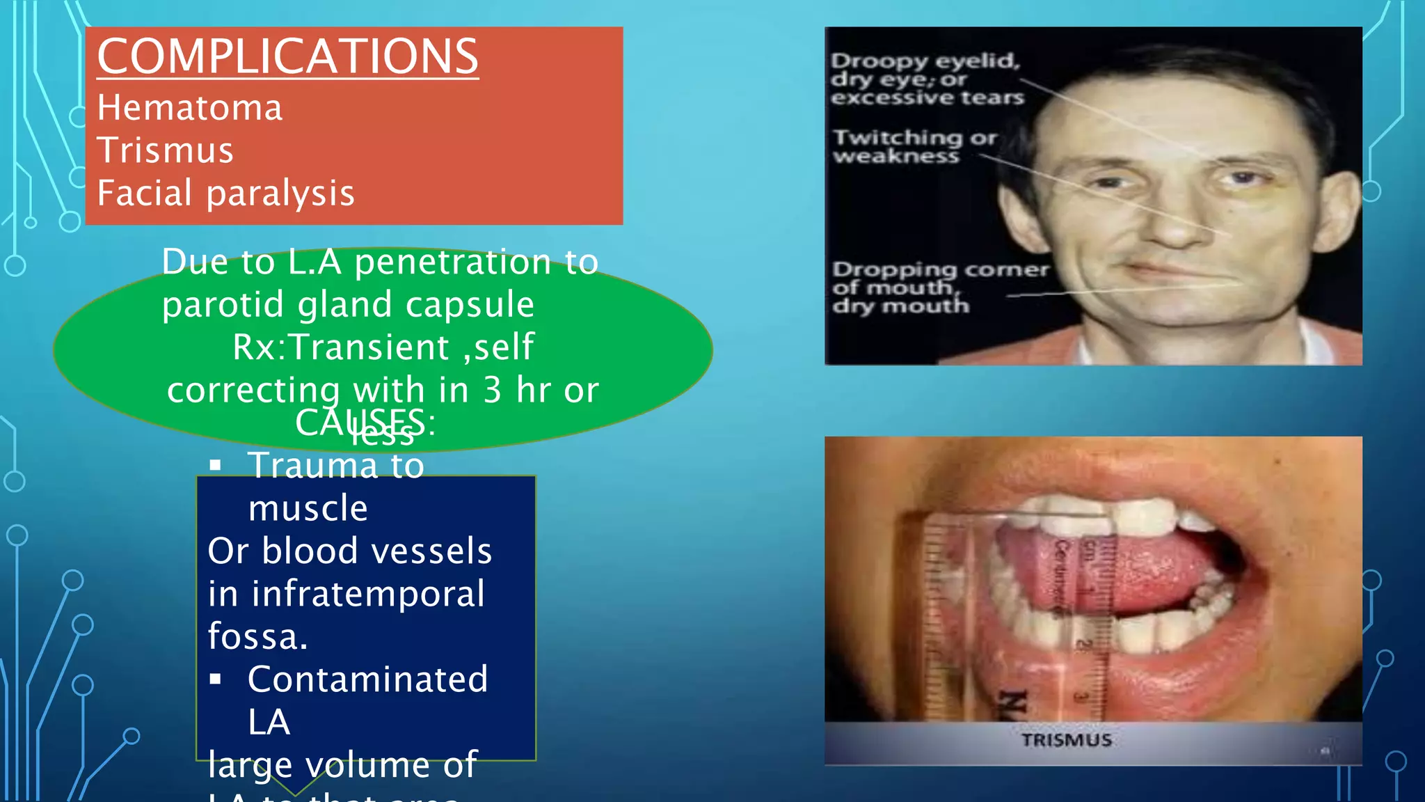 COMPLICATIONS
Hematoma
Trismus
Facial paralysis
Due to L.A penetration to
parotid gland capsule
Rx:Transient ,self
correcting with in 3 hr or
less
CAUSES:
 Trauma to
muscle
Or blood vessels
in infratemporal
fossa.
 Contaminated
LA
large volume of
 