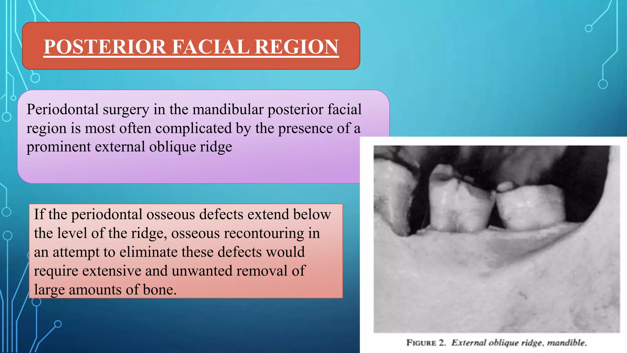 POSTERIOR FACIAL REGION
Periodontal surgery in the mandibular posterior facial
region is most often complicated by the presence of a
prominent external oblique ridge
If the periodontal osseous defects extend below
the level of the ridge, osseous recontouring in
an attempt to eliminate these defects would
require extensive and unwanted removal of
large amounts of bone.
 