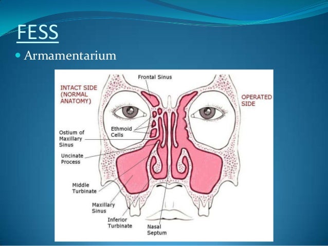 Surgical anatomy of maxillary sinus – note on (2)