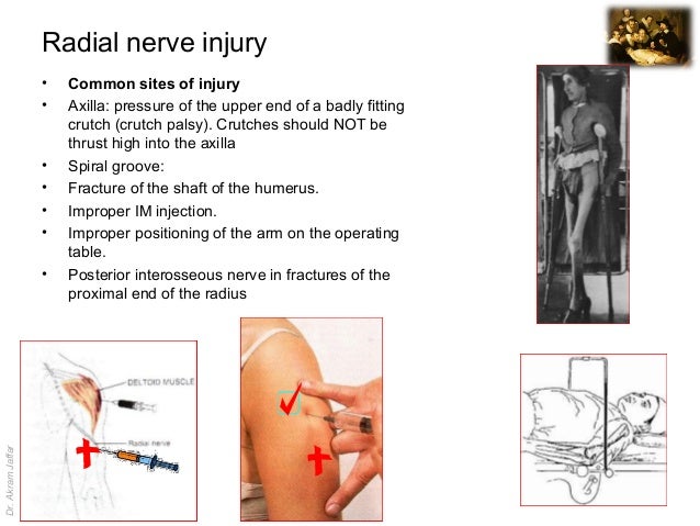Surgical anatomy of nerve and vascular injuries in the upper limb