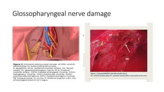 Glossopharyngeal nerve damage
 