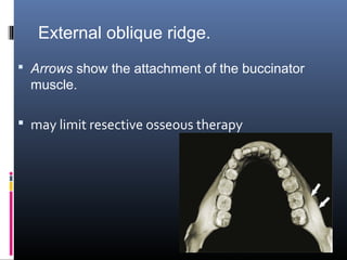 External oblique ridge.
 Arrows show the attachment of the buccinator
muscle.
 may limit resective osseous therapy
 