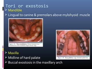 Tori or exostosis
 Mandible
 Lingual to canine & premolars above mylohyoid muscle
 Maxilla
 Midline of hard palate
 Buccal exostosis in the maxillary arch
 
