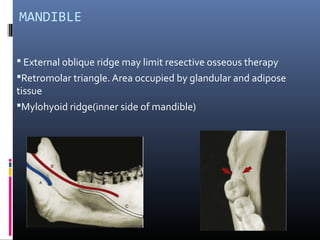 MANDIBLE
 External oblique ridge may limit resective osseous therapy
Retromolar triangle. Area occupied by glandular and adipose
tissue
Mylohyoid ridge(inner side of mandible)
 