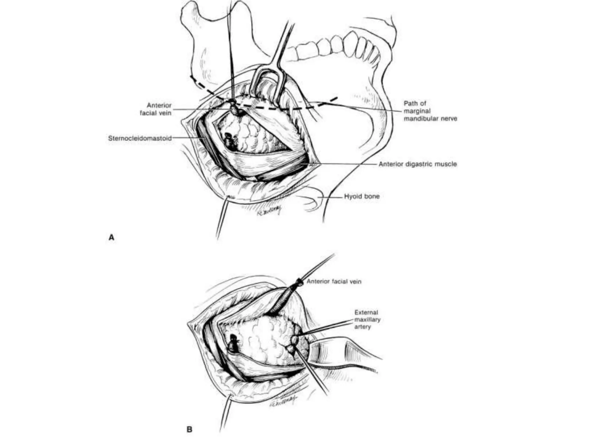 Surgical anatomy of salivary glands | PPTX