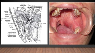 Surgical anatomy of salivary glands | PPTX