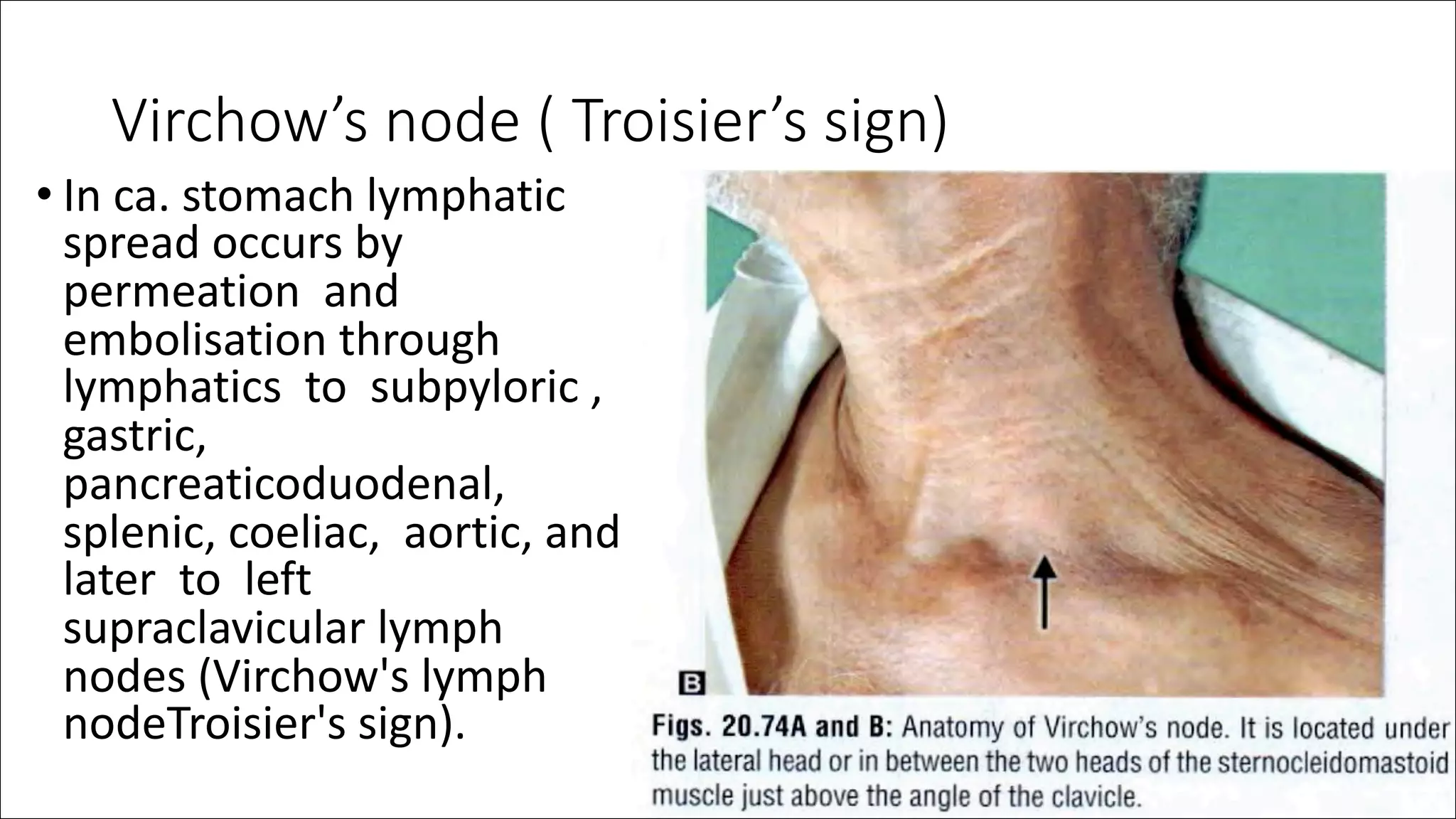 Toisier Sign SURGICAL ANATOMY OF STOMACH AND DUODENUM dr. bruhath^final. .pdf