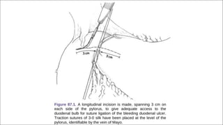 SURGICAL ANATOMY OF STOMACH AND DUODENUM dr. bruhath^final. .pdf