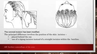 Circumcoronal Incision Surgical anatomy of tmj | PPTX