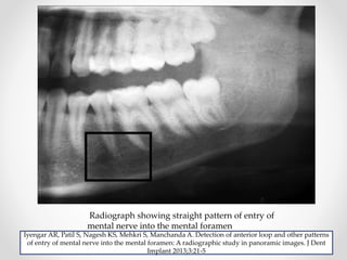 IMPORTANT ANATOMICAL CONSIDERATIONS IN PERIODONTAL SURGERY AND IMPLANTS ...