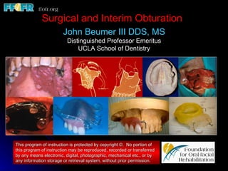 Surgical and Interim Obturation John Beumer III DDS, MS Distinguished Professor Emeritus UCLA School of Dentistry This program of instruction is protected by copyright ©.  No portion of this program of instruction may be reproduced, recorded or transferred by any means electronic, digital, photographic, mechanical etc., or by any information storage or retrieval system, without prior permission. 