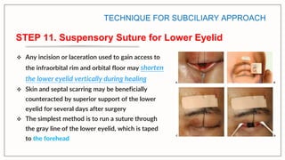 Subciliary Approach Incision surgical approaches to facial skeleton -periorbital.pptx