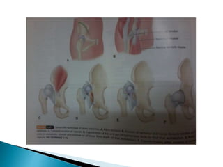 Hip Transposition Surgical approaches to hip | PPTX