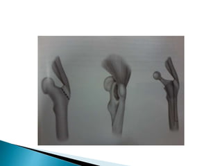Moore Approach Surgical approaches to hip | PPTX