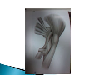 Moore Approach Surgical approaches to hip | PPTX