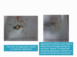 Moore Approach Surgical approaches to hip | PPTX