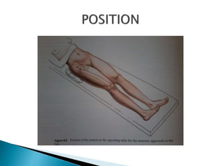Moore Approach Surgical approaches to hip | PPTX