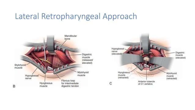 Surgical approaches to the CCJ.pptx