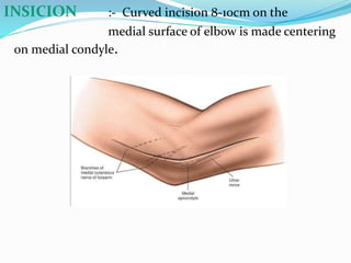 INSICION :- Curved incision 8-10cm on the
medial surface of elbow is made centering
on medial condyle.
 