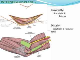 INTERNERVOUS PLANE :-
Proximally:
Brachialis &
Triceps
Distally:
Brachialis & Pronator
Teres
 