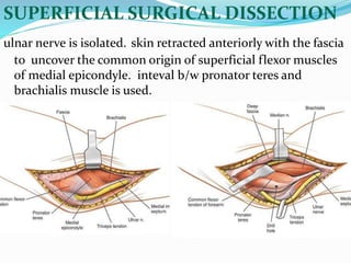 SUPERFICIAL SURGICAL DISSECTION
ulnar nerve is isolated. skin retracted anteriorly with the fascia
to uncover the common origin of superficial flexor muscles
of medial epicondyle. inteval b/w pronator teres and
brachialis muscle is used.
 