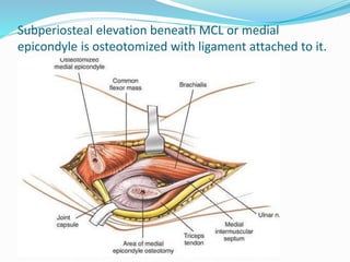 Subperiosteal elevation beneath MCL or medial
epicondyle is osteotomized with ligament attached to it.
 