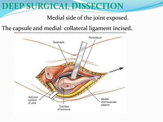 DEEP SURGICAL DISSECTION
Medial side of the joint exposed.
The capsule and medial collateral ligament incised.
 