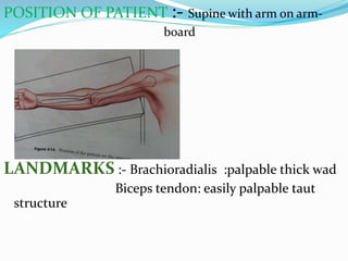 POSITION OF PATIENT :- Supine with arm on arm-
board
LANDMARKS :- Brachioradialis :palpable thick wad
Biceps tendon: easily palpable taut
structure
 