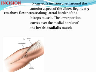INCISION :- curved S incision given around the
anterior aspect of the elbow. Begins at 5
cm above flexor crease along lateral border of the
biceps muscle. The lower portion
curves over the medial border of
the brachioradialis muscle
 