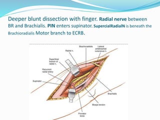 Deeper blunt dissection with finger. Radial nerve between
BR and Brachialis. PIN enters supinator. SupercialRadialN is beneath the
Brachioradialis Motor branch to ECRB.
 
