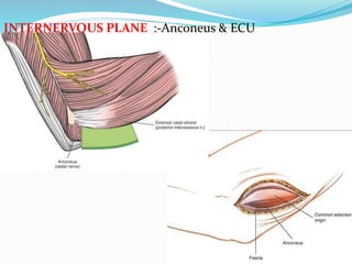 INTERNERVOUS PLANE :-Anconeus & ECU
 