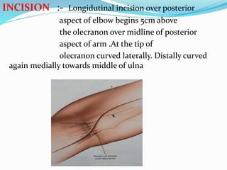 INCISION :- Longidutinal incision over posterior
aspect of elbow begins 5cm above
the olecranon over midline of posterior
aspect of arm .At the tip of
olecranon curved laterally. Distally curved
again medially towards middle of ulna
 