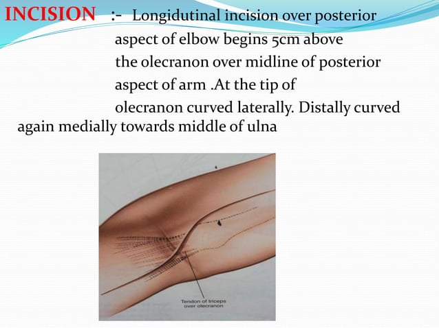 Surgical approaches to the elbow | PPTX | Death, Injury, or Military ...