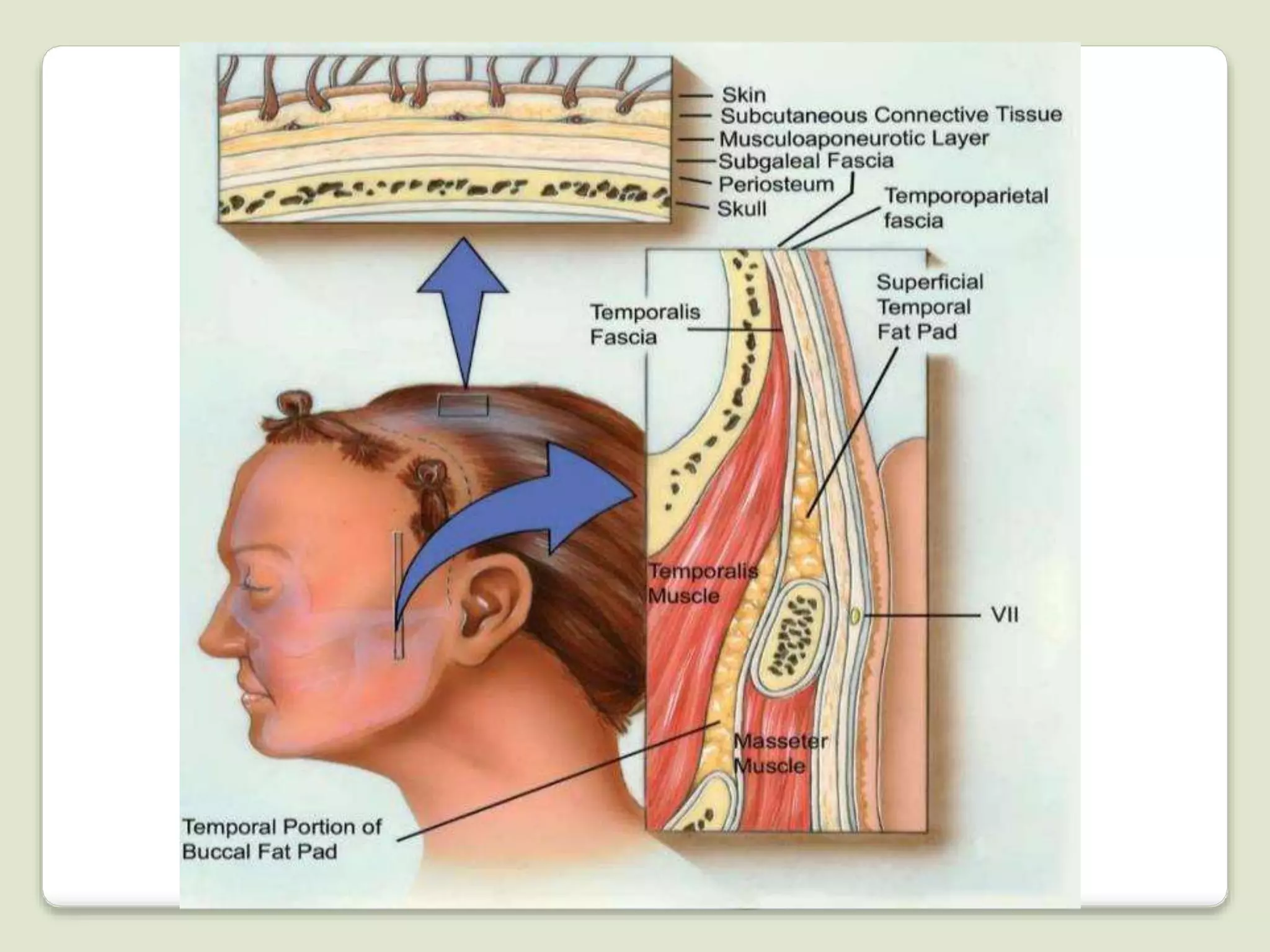Surgical approaches to the facial skeleton | PPTX
