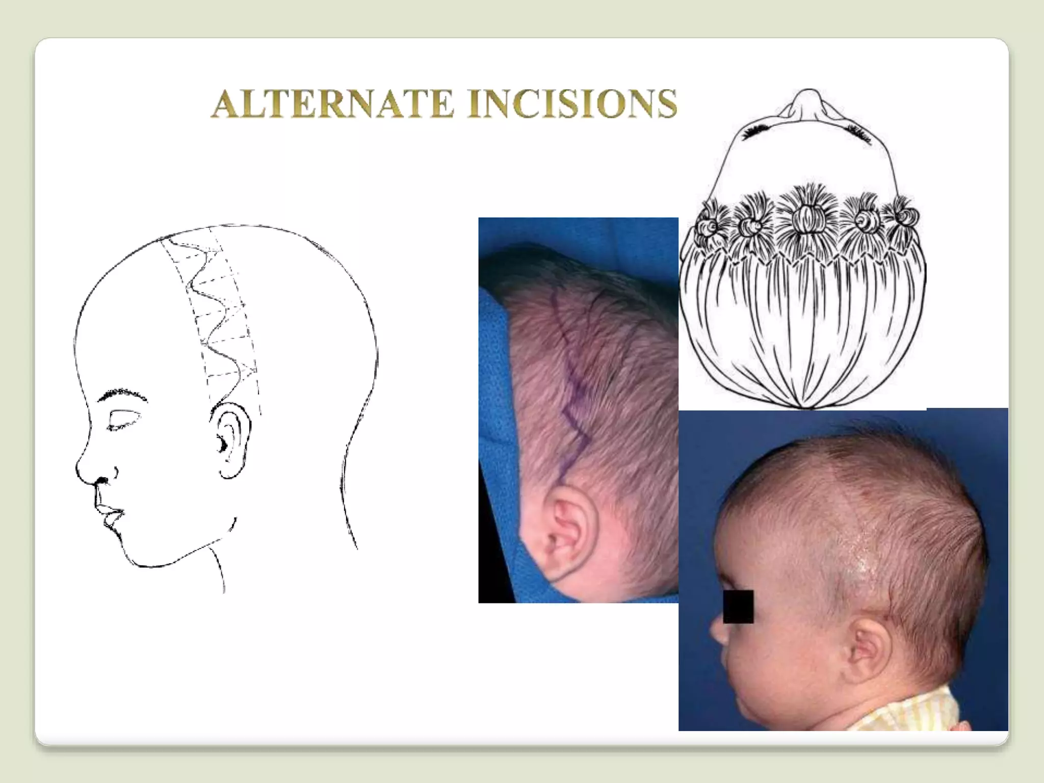 Surgical approaches to the facial skeleton | PPTX