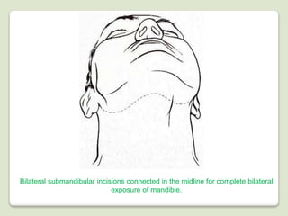 Complete Midline Incision Surgical approaches to the facial skeleton | PPTX