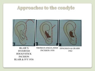Surgical approaches to the facial skeleton | PPTX