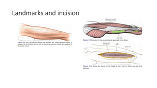 Surgical Approaches to the Femur.pptx