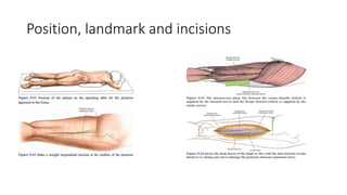 Surgical Approaches to the Femur.pptx