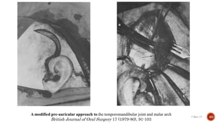 Retroauricular Approach Surgical approaches to tmj | PPTX