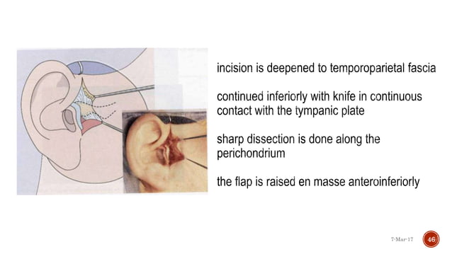 Tm Injection Surgical approaches to tmj | PPTX | Ear, Nose and Throat Conditions ...