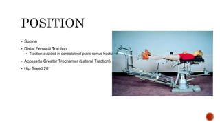 Distal Traction Rotation Surgical approach to acetabulum and pelvis | PPTX