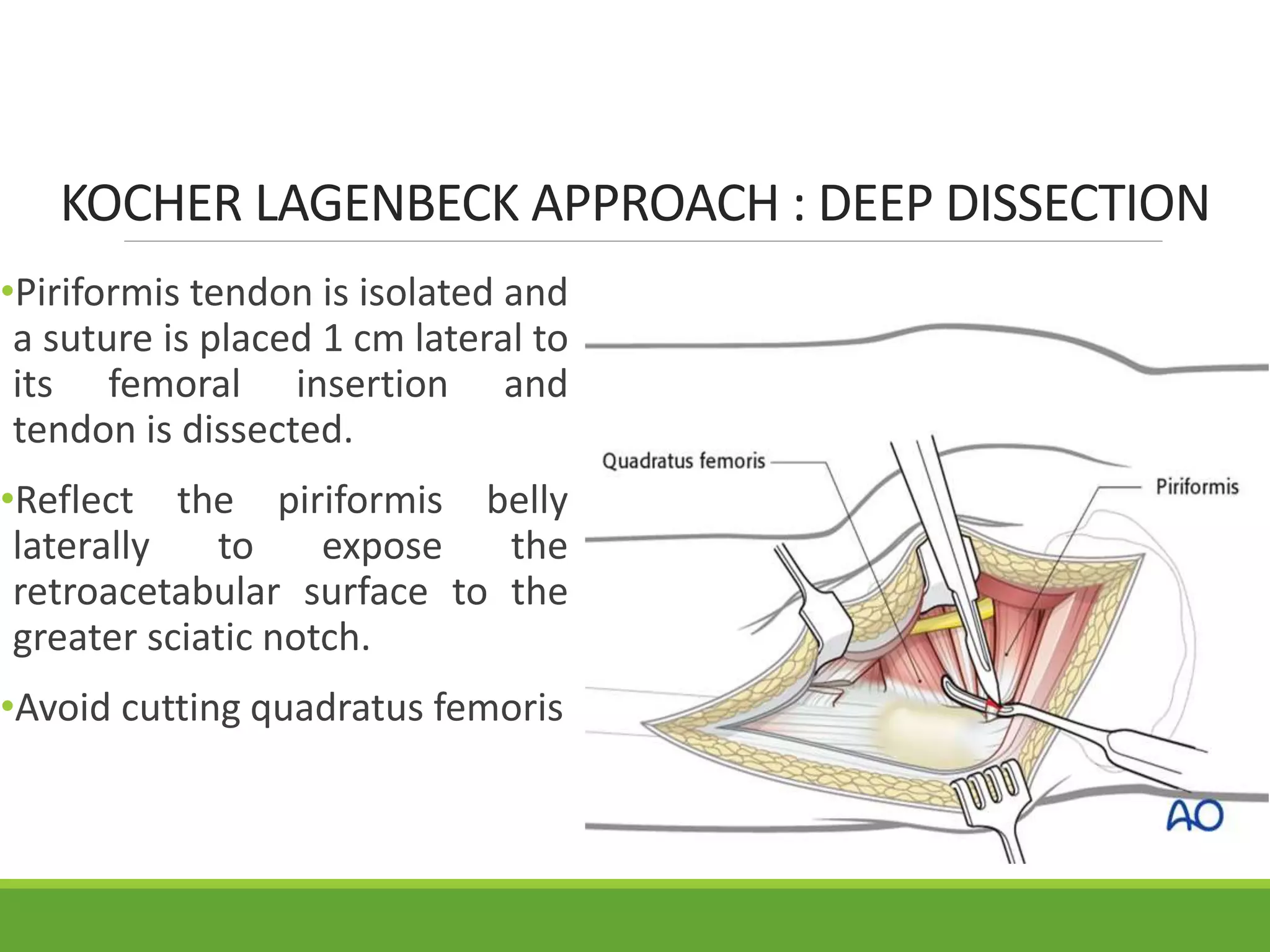 Surgical Approaches to Acetabulum and Pelvis | PPTX