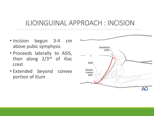 Intrapelvic Surgical Approaches to Acetabulum and Pelvis | PPTX