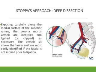 Surgical Approaches to Acetabulum and Pelvis | PPTX