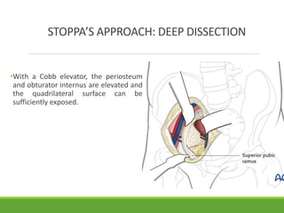 Surgical Approaches to Acetabulum and Pelvis | PPTX