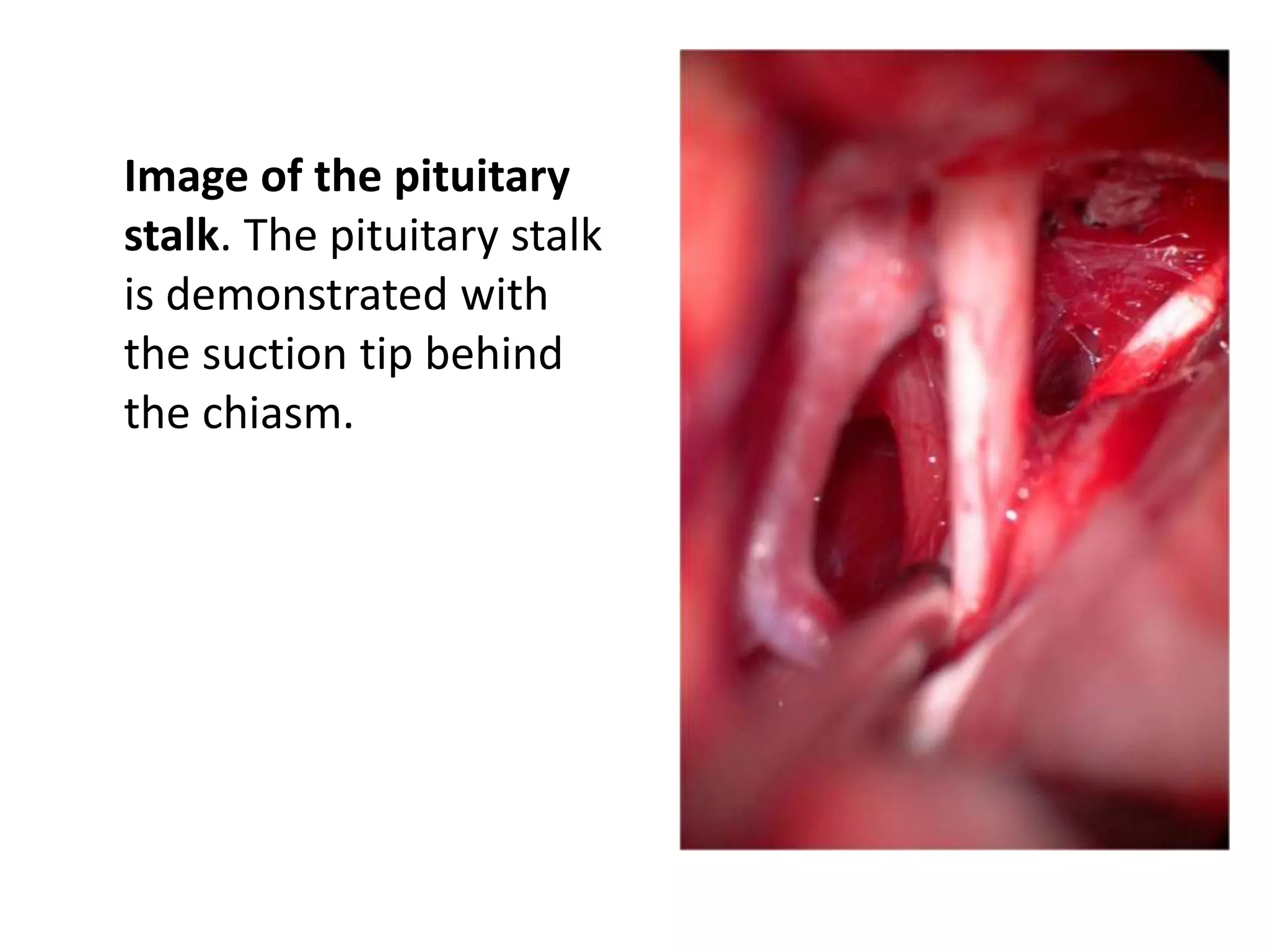 Image of the pituitary
stalk. The pituitary stalk
is demonstrated with
the suction tip behind
the chiasm.
 