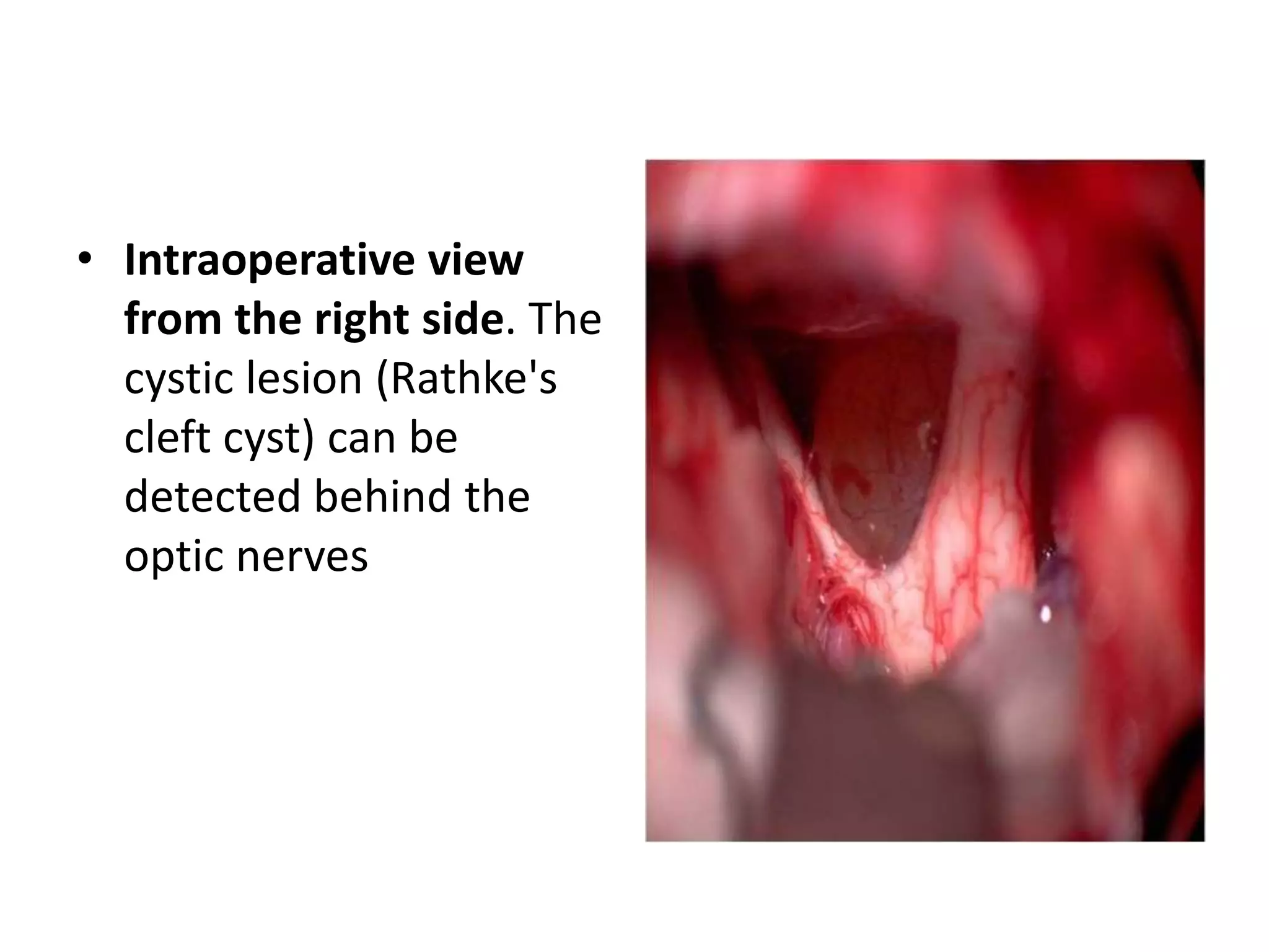 • Intraoperative view
from the right side. The
cystic lesion (Rathke's
cleft cyst) can be
detected behind the
optic nerves
 